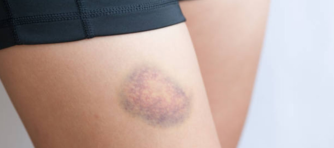 Evo kako nastaju sve one misteriozne masnice na vašem tijelu!